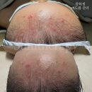 숨 피부관리 | 울산 피부관리 여드름 걱정없는 숨테라피 후기