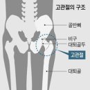 "뼈가 썩는 병… 술이 고관절까지 망칩니다" 이미지