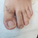 포쉬네일 풀리메디 안산점 | 시흥내성발톱 차원이 달랐던 전문관리 포쉬네일 풀리메디 안산점