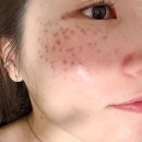 남영반점 | 피코슈어트리플토닝 + 잡티레이저 6걔월 내돈내산 후기