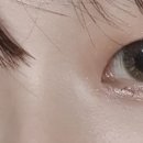 개슴츠레 | [쌍수일기 2탄] 비절개(매몰) + 눈매교정 쌍수 당일 ~ 3일차 후기
