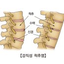 강직성 척추염 이미지