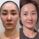 수원 세류동 피부관리 문샵 수원점 프리미엄 리프팅 케어 후기