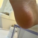 동성메디칼 | 군포발각질 풋네일 동성제약 풀리메디 군포산본점 추천드려요