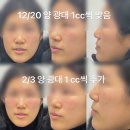 서울 강남 신논현 ) 와우성형외과의원 앞광대 필러 추가 후기