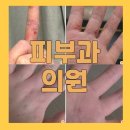 별내 피부과 접촉성피부염 후기