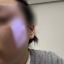 큐어람한의원 | 얼굴 편평사마귀 제거 대만족 찐후기