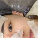 끌림365의원 | 여드름,흉터고민때문에 골드PPT 앰플/레이저 내돈내산 후기