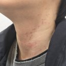 밝은한의원 | 강서 가양역 한의원 남자 목 편평사마귀 제거 거우침 리얼 후기