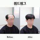 수원-0670 | 수원가발 인모가발 후기 무약품 고정식가발 착용방법