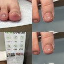 선천남로 | 김해 내성발톱 관리받고 편안해진곳 후기