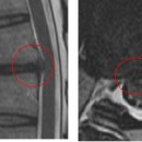 이지훈 님의 흉추디스크 T7-8의 MRI사진 판독입니다. 이미지