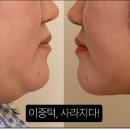 셀업성형외과의원 | 이중턱시술후기 셀업성형외과의 리얼스토리