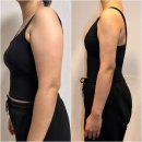 지방 | 강남 교대 팔뚝지방흡입 후기 (부작용, 지흡 발품, 병원 비교)