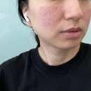 기린성형외과의원 | 30대 후반 동안 비결?! 요즘 유행하는 줄기세포주사 + 울쎄라 300샷 전후 변화