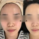 백설공주 래쉬 | 홍조 피부 제대로 관리받고 온 후기 관저동 피부관리 추천 '메디유스킨' 관리 비용, 변화 후기