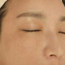 센텀2로 | 부산 광안동 근처 피부과 색소침착 관리 기미레이저 대신 컨텍터 5회차 후기