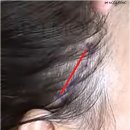 모즈의원 | 50대 주름과 얼굴 처짐, 미니거상이 답이 될 수 있습니다
