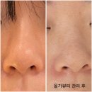 디톡스 | 올가드림뷰터 화봉점 모공디톡스 후기