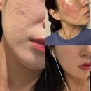 1회 사진기록전 | 성형외과전문의 피부과 울트라펄스알파 여드름흉터레이저 후기 | 내돈내산 1회차 변화 기록 (전후사진)