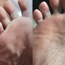 카네스텐크림 약국 연고 발백선 후기