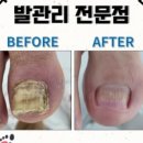 레푸스증포