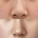 복코돼지 | [콧볼축소+연골묶기 후기] 내돈내산! 복코탈출 외측절개 2주차 17일차 붓기 흉터 상담후기까지