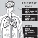 혈전 심해지기 전에 나타나는 증상 7가지 이미지