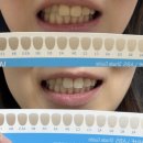 화이트부러쉬 | 화이트랩스 셀프 치아미백 2인 내돈내산 사용후기 결혼준비 예신,예랑 추천