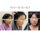 다정한약국 | 강남 피부과 전문의 병원 민트실리프팅 보톡스 솔직 시술 후기