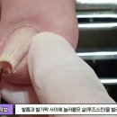 얼마나 아프셨을까요?ㅠㅠ 역대급으로 돌돌말린 #내성발톱 #파고드는발톱 #내향성발톱 이미지