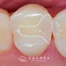 수복약국 | 문정역 치과, 인레이·온레이·크라운 차이 쉽게 알려드립니다