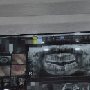 코코치과의원 | 광주 쏙쏙 사랑니 치과 2번째후기!