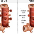 음식과 질환 - 게실염 이미지
