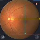 아이윤병원 | [망막중심동맥폐쇄] 약물치료 후기