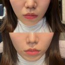 유투성형외과의원 | 팔자주름 자가진피재생술 압구정피부과유명한곳 후기