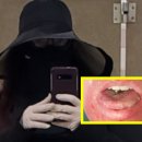 햇빛에 30초만 노출돼도 3도 화상, 뱀파이어처럼 사는 英여성 이미지