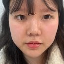 제이뉴피부과의원 | 선릉역 피부과 골드제이의원 | 티타늄 리프팅·쥬베룩볼륨·볼패임 시술 솔직 후기