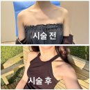 제니성형외과 | 압구정역 성형외과에서 받은 더채움 어깨필러 후기! 자연스러운 제니어깨 완성