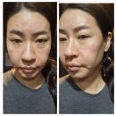 톡스앤필의원 | 톡스앤필의원 안산점 쥬베룩 스킨부스터후기