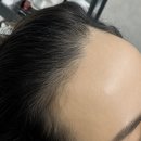 헤어라인문신 진접 채움 후기와 꼭 확인해야할 4가지