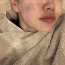 3000 | 비본영의원 쿨소닉 리프팅 3000샷 솔직후기 추천!