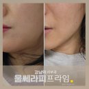 라임피부 | 강남역피부과 울쎄라피프라임 살없는 피부 받아본 효과 후기