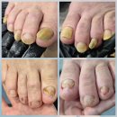 광주365재활병원 | 광주 365재활병원으로 무좀발톱 출장네일 다녀왔어요.