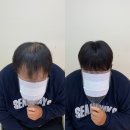 울산증모술 우정동미용실&amp;wig , 티안나게 탈모커버 잘하는곳으로 추천 !