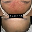 톤업에스테틱 | 청주피부관리 전후가 확실히 차이났던 복대동 톤업에스테틱 여드름 관리 솔직 후기