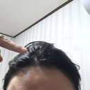 진생약국 | 미녹시딜 내돈내산 마이녹실 여자 솔직후기 전후 3개월차 광고X