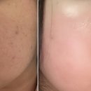 부평 피부관리 어반뷰티살롱 여드름흔적 케어 후기! 에어플라 관리 후기, 추천