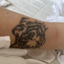 스마트맨의원 | 잠실 스마트의원 타투제거 2회차 일자별 정리ㅠ 25년 6월