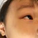 못골이비인후과의원 | 부산 대연동안과 대연성모안과 후기 아이 눈 옆 찢어짐